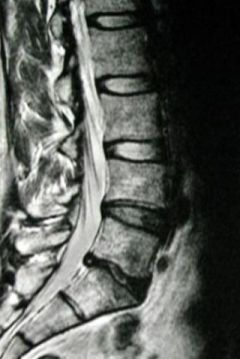 Interpolation for men without the syndrome