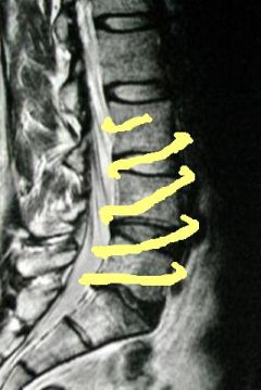 Interpolation for men with the syndrome